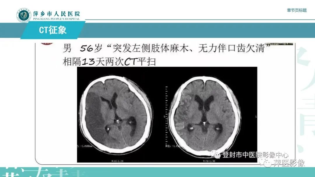 影像PPT - 【PPT】脑皮质层状坏死的影像诊断-18