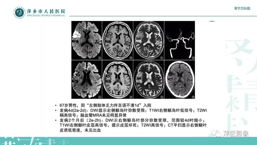 影像PPT - 【PPT】脑皮质层状坏死的影像诊断-20