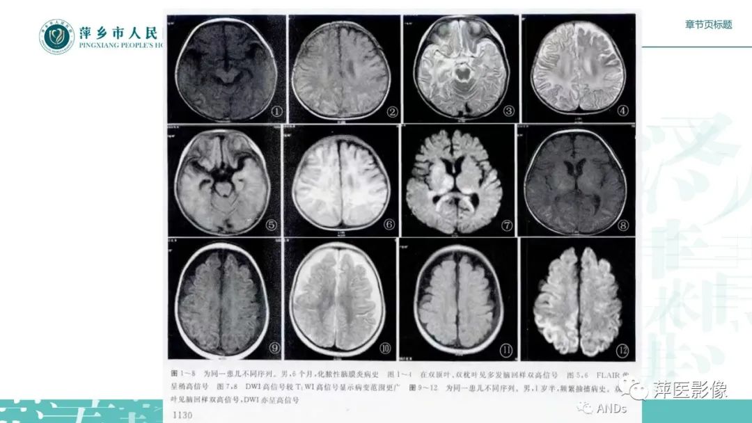 影像PPT - 【PPT】脑皮质层状坏死的影像诊断-21