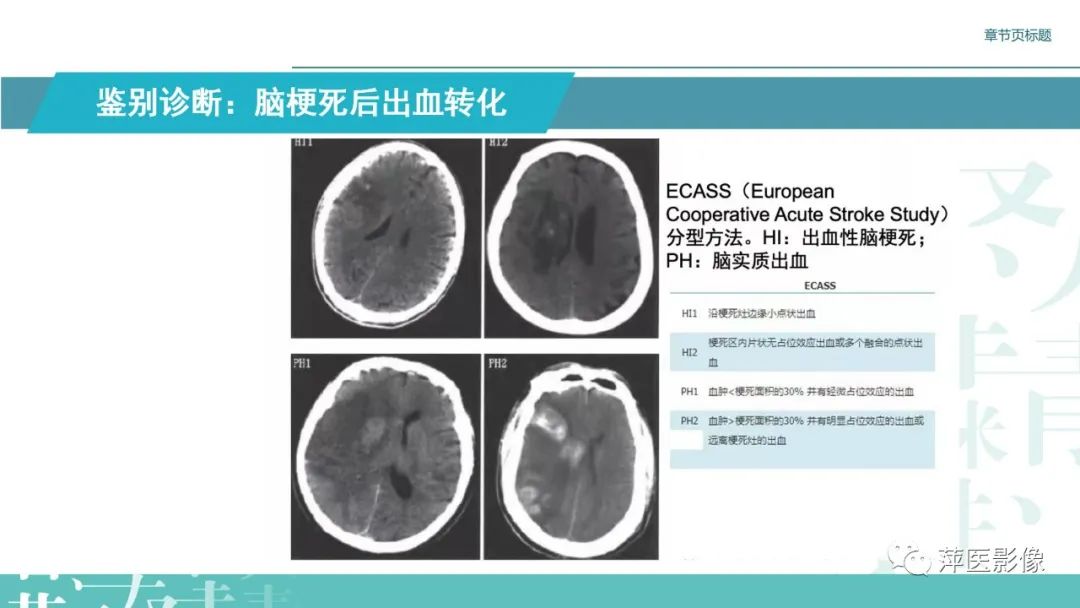 影像PPT - 【PPT】脑皮质层状坏死的影像诊断-27