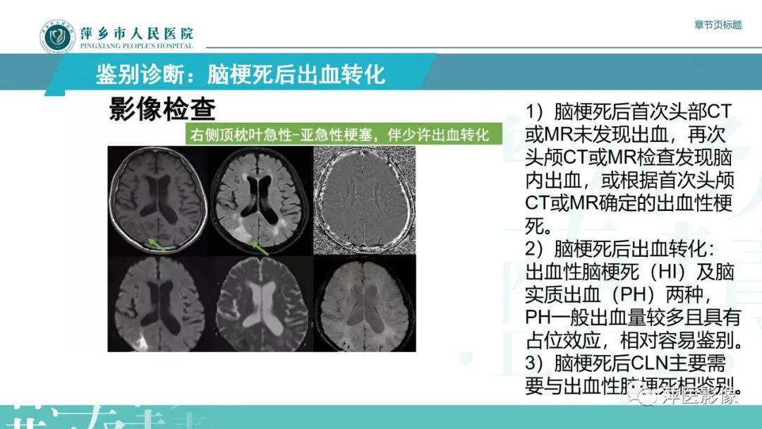 影像PPT - 【PPT】脑皮质层状坏死的影像诊断-26
