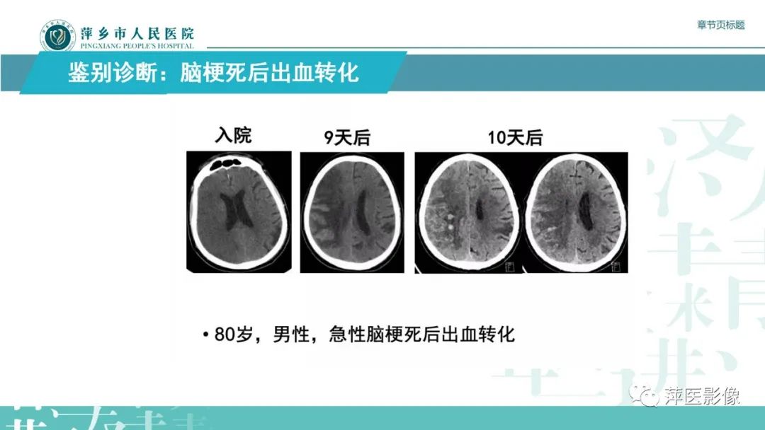 影像PPT - 【PPT】脑皮质层状坏死的影像诊断-28