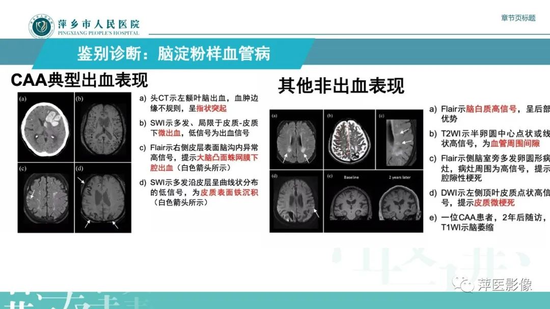 影像PPT - 【PPT】脑皮质层状坏死的影像诊断-31