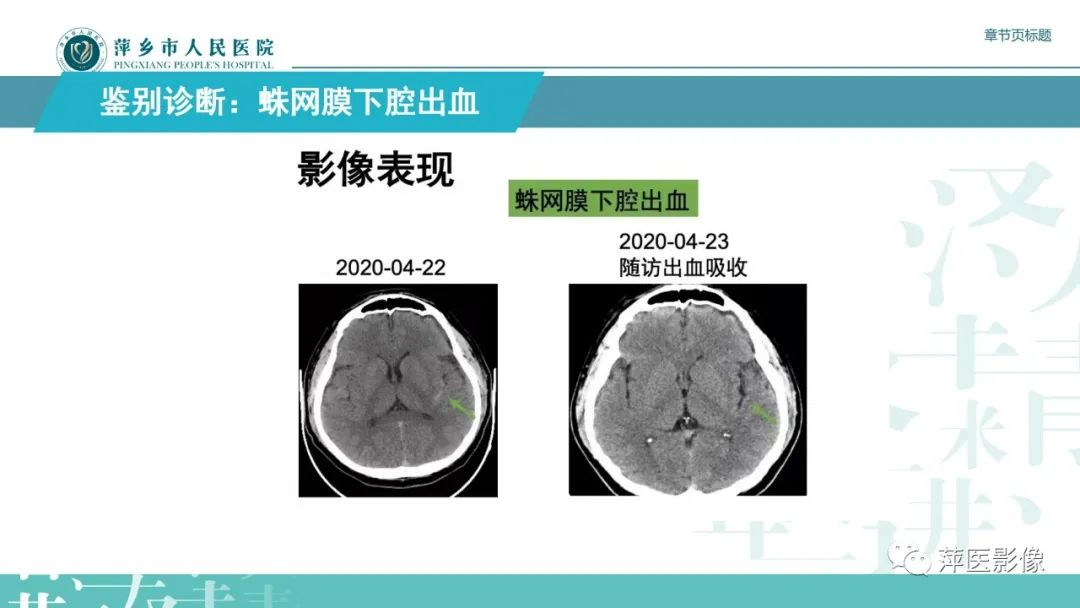 影像PPT - 【PPT】脑皮质层状坏死的影像诊断-33