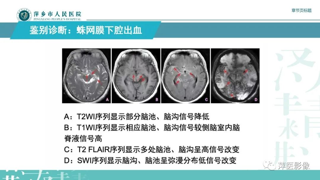 影像PPT - 【PPT】脑皮质层状坏死的影像诊断-34
