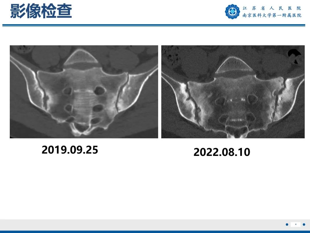 影像PPT - 【PPT】强直性脊柱炎-5