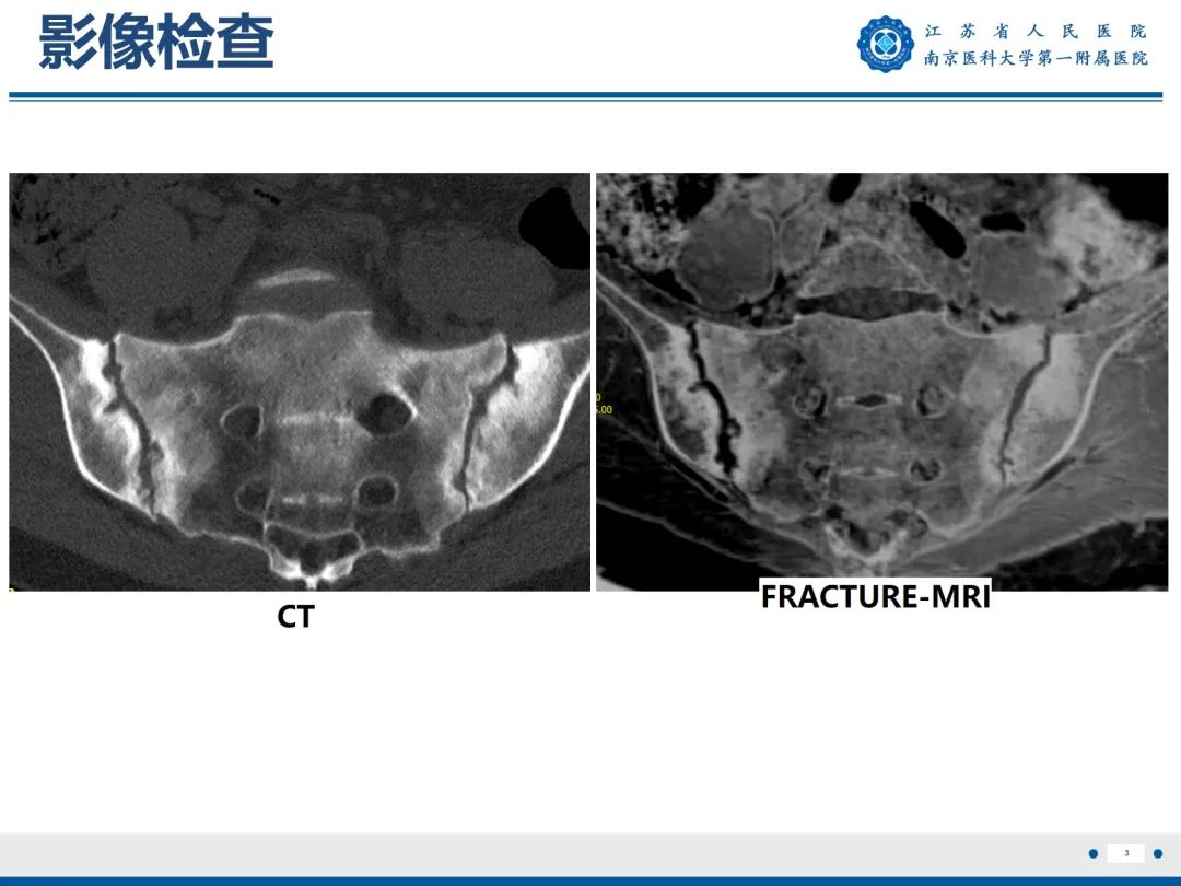 影像PPT - 【PPT】强直性脊柱炎-4