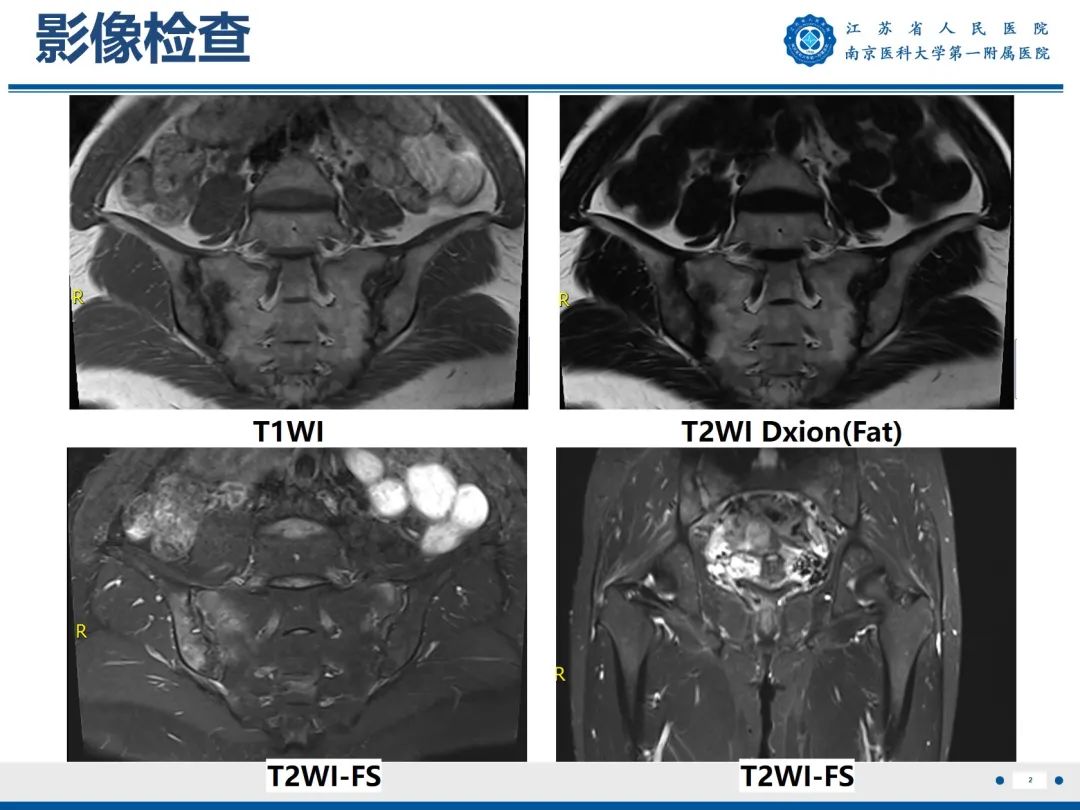 影像PPT - 【PPT】强直性脊柱炎-3