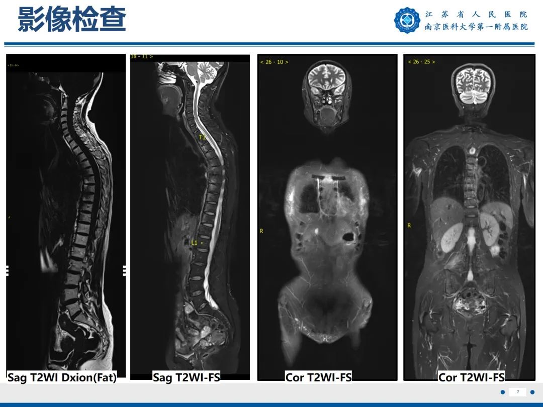 影像PPT - 【PPT】强直性脊柱炎-8