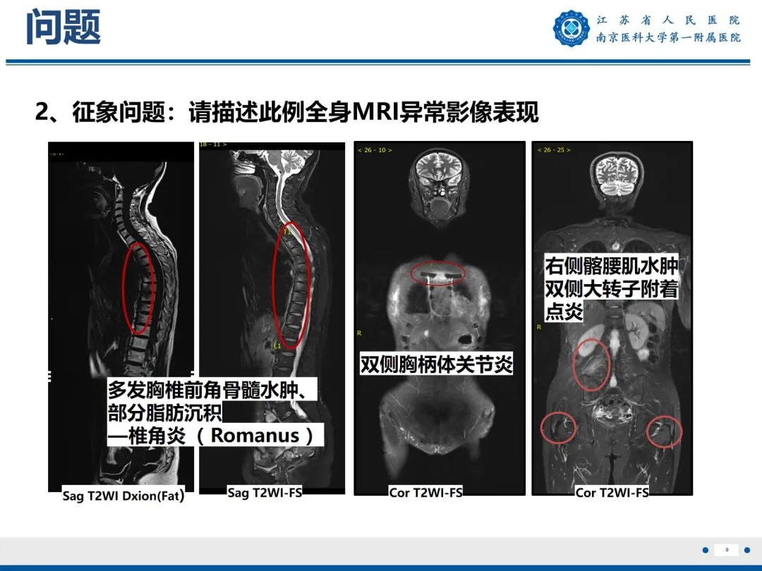 影像PPT - 【PPT】强直性脊柱炎-10