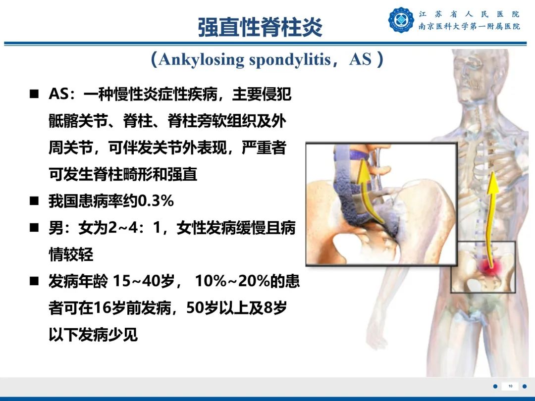 影像PPT - 【PPT】强直性脊柱炎-11
