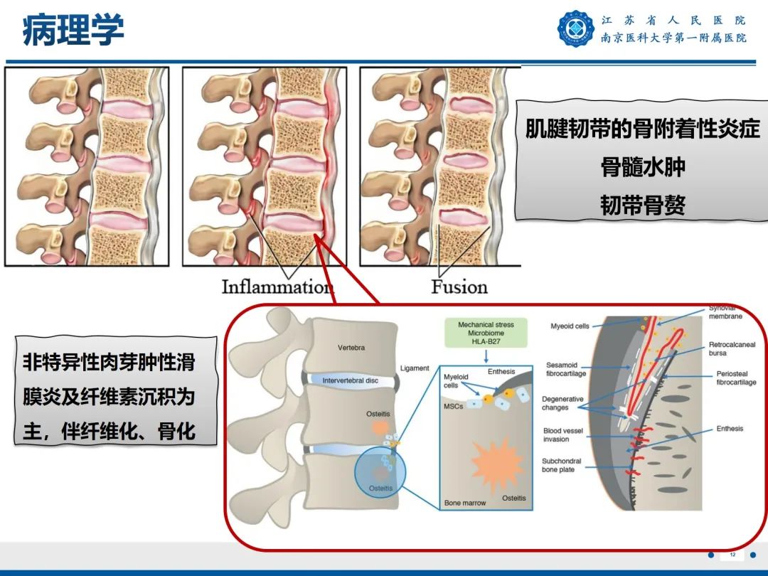 影像PPT - 【PPT】强直性脊柱炎-13