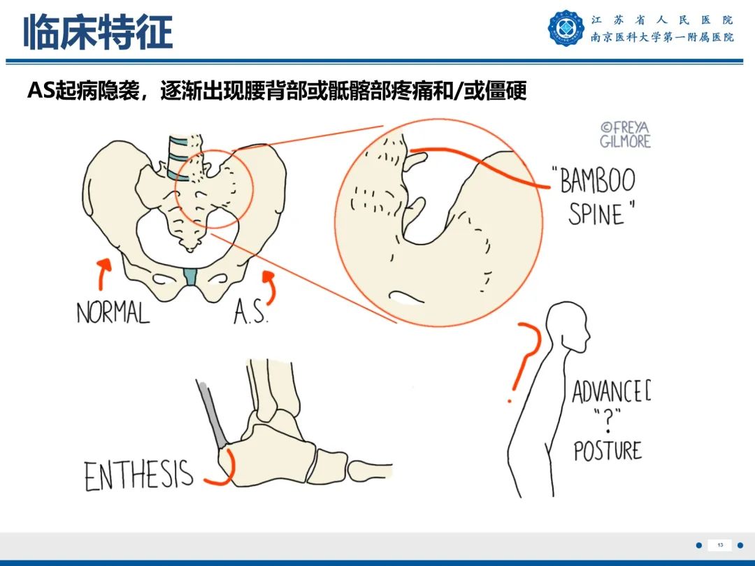 影像PPT - 【PPT】强直性脊柱炎-14