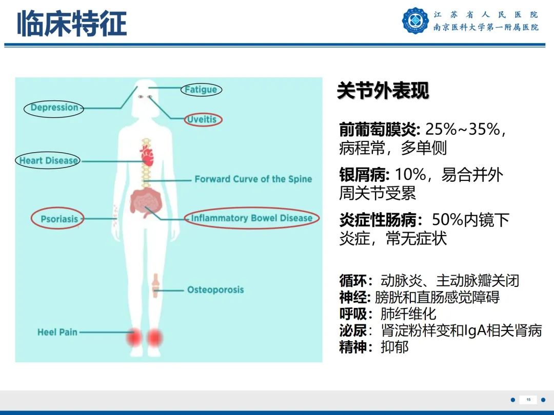 影像PPT - 【PPT】强直性脊柱炎-16