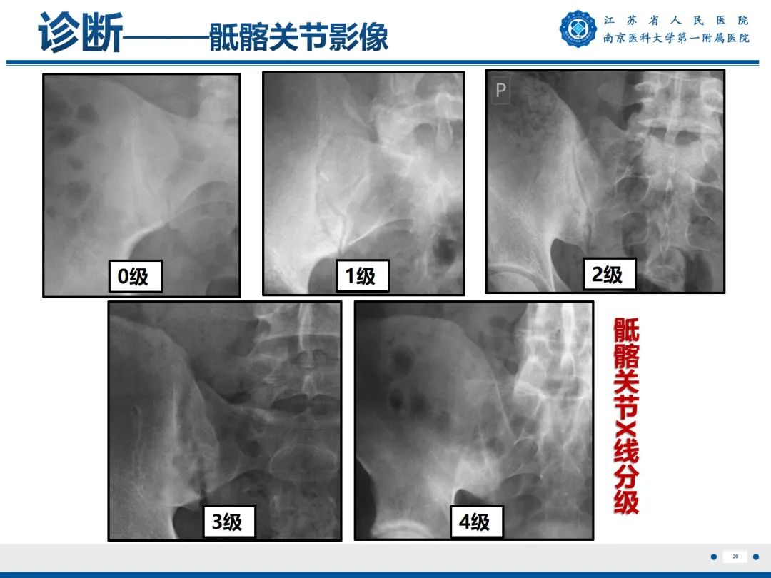 影像PPT - 【PPT】强直性脊柱炎-21