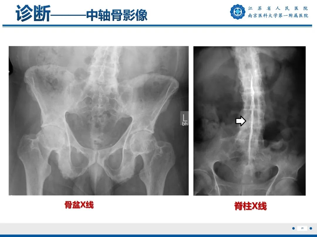 影像PPT - 【PPT】强直性脊柱炎-22