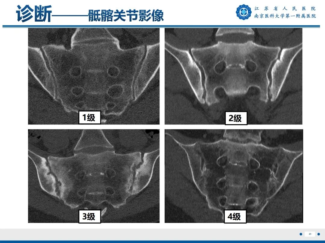影像PPT - 【PPT】强直性脊柱炎-24