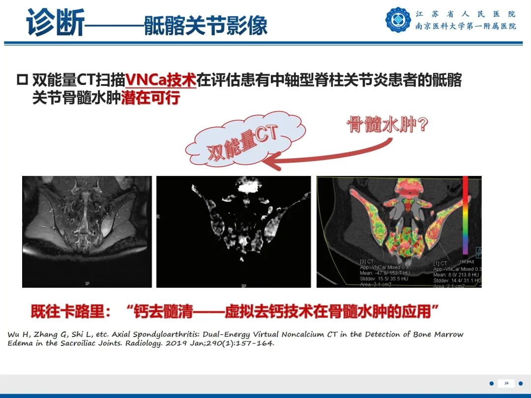 影像PPT - 【PPT】强直性脊柱炎-25