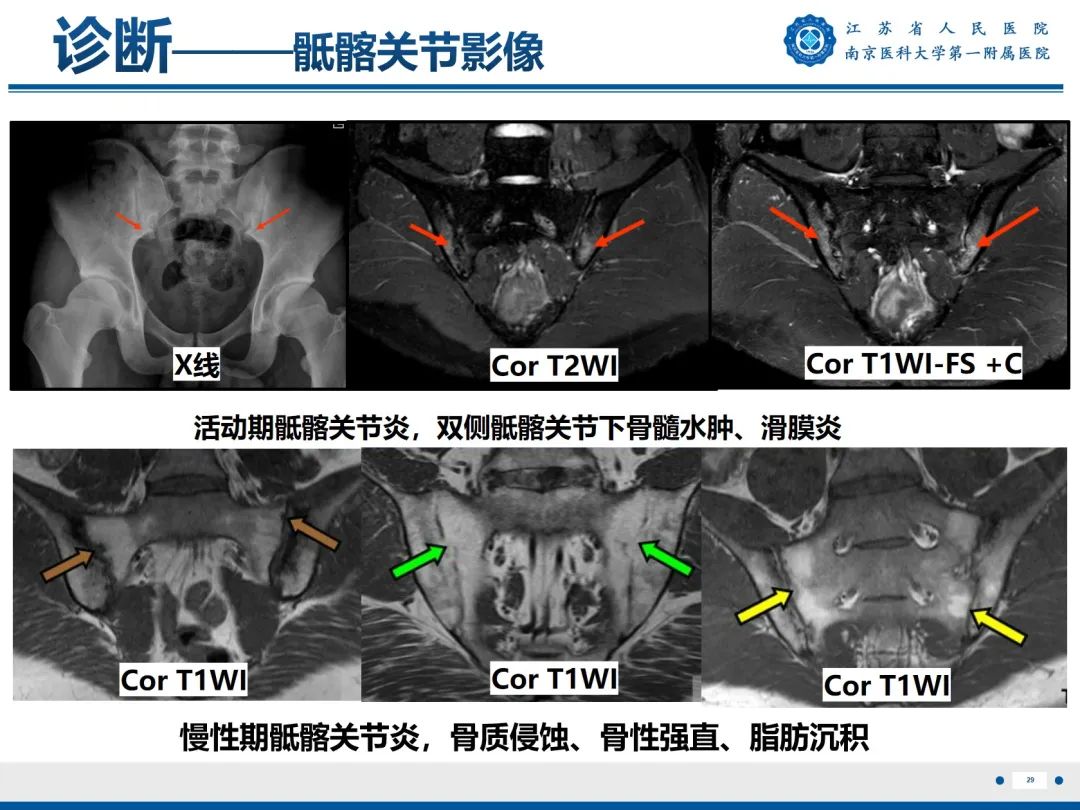 影像PPT - 【PPT】强直性脊柱炎-30