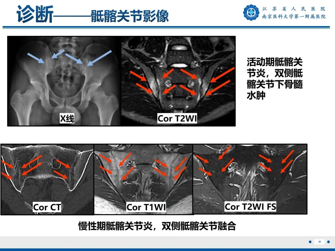 影像PPT - 【PPT】强直性脊柱炎-29