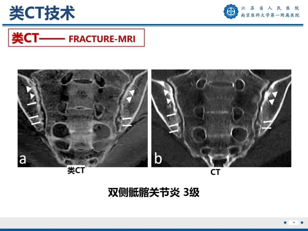 影像PPT - 【PPT】强直性脊柱炎-35