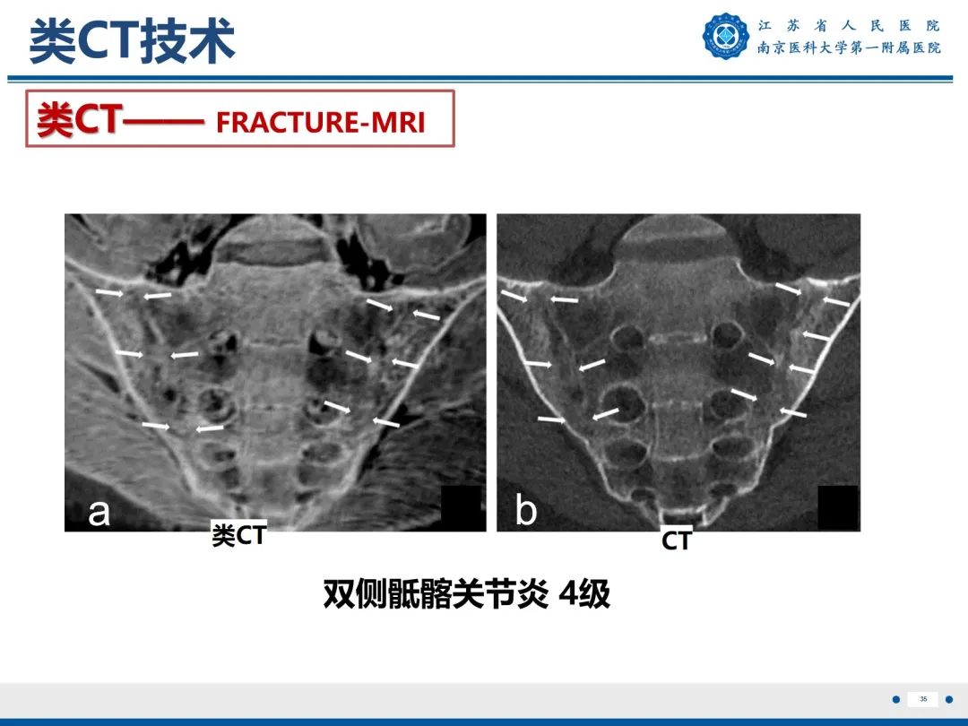 影像PPT - 【PPT】强直性脊柱炎-36