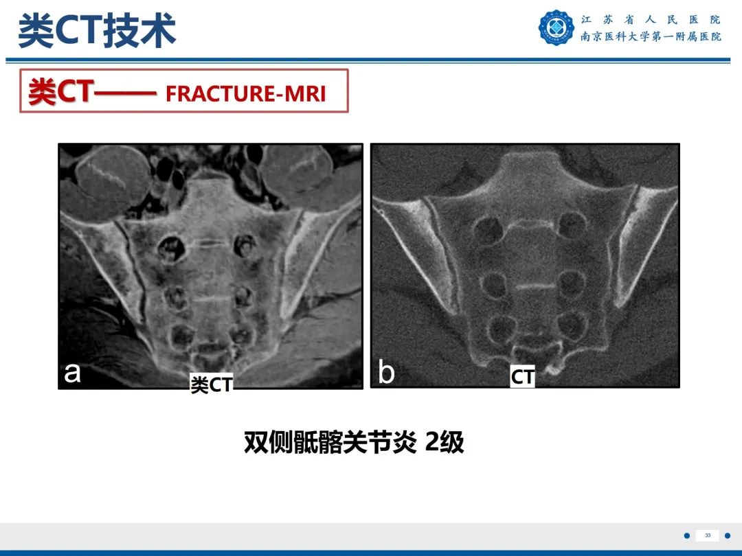 影像PPT - 【PPT】强直性脊柱炎-34