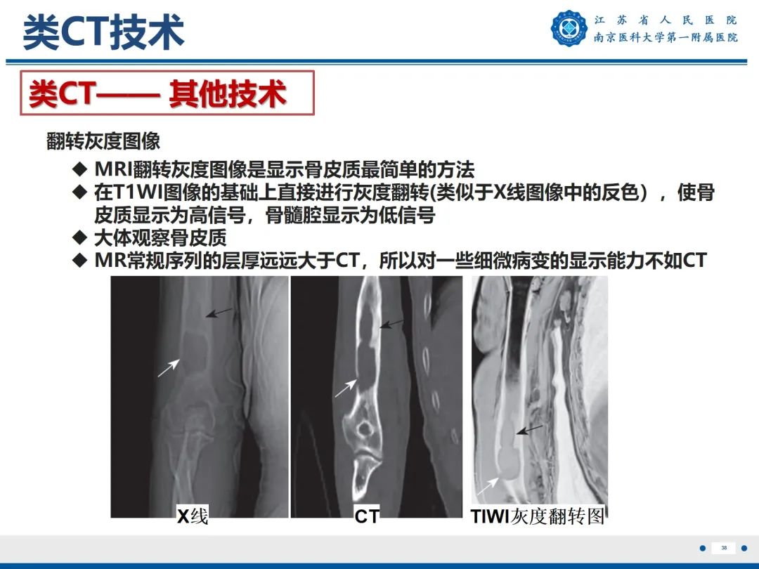 影像PPT - 【PPT】强直性脊柱炎-39