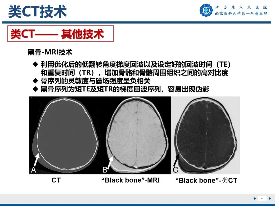 影像PPT - 【PPT】强直性脊柱炎-43