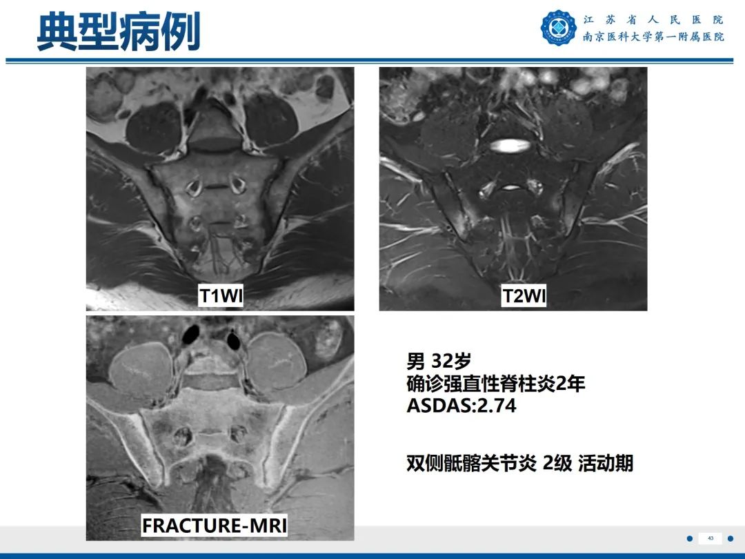 影像PPT - 【PPT】强直性脊柱炎-44