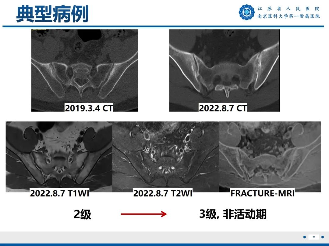 影像PPT - 【PPT】强直性脊柱炎-45