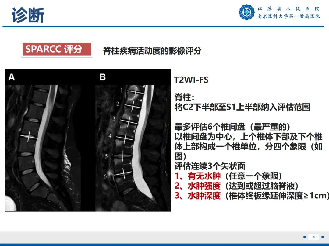 影像PPT - 【PPT】强直性脊柱炎-47