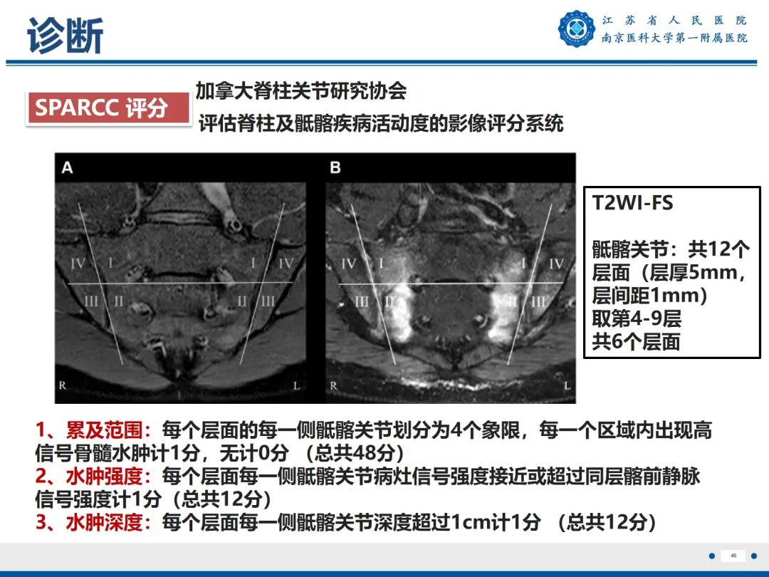 影像PPT - 【PPT】强直性脊柱炎-46