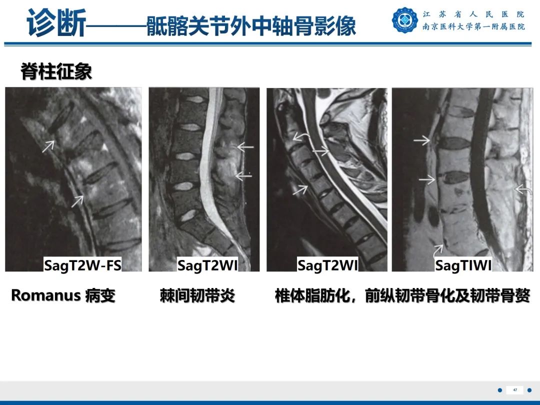 影像PPT - 【PPT】强直性脊柱炎-48