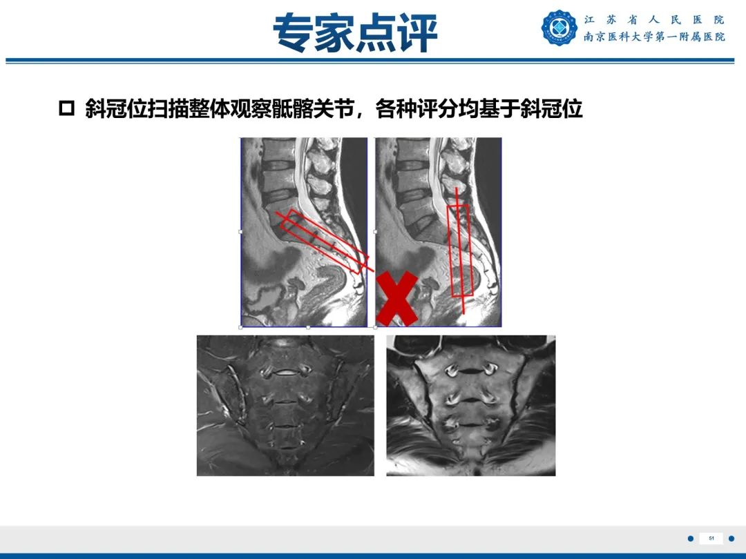 影像PPT - 【PPT】强直性脊柱炎-52