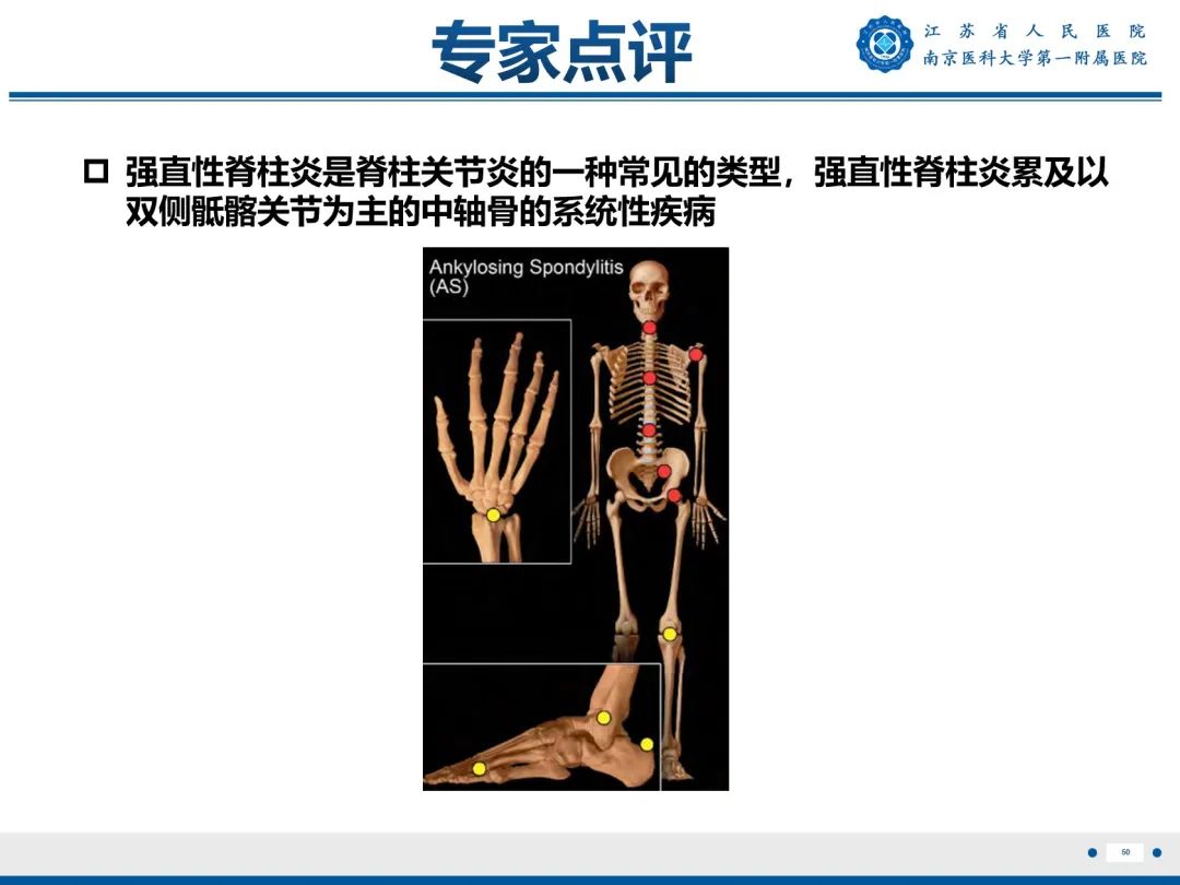 影像PPT - 【PPT】强直性脊柱炎-51