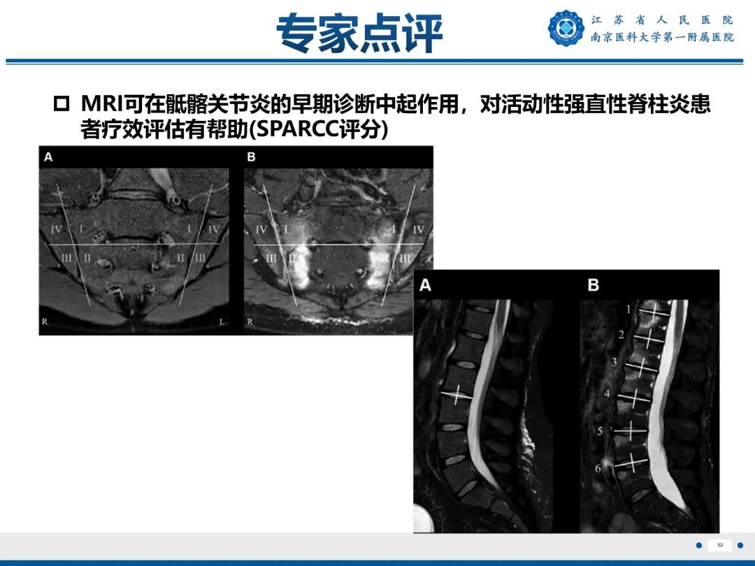 影像PPT - 【PPT】强直性脊柱炎-53