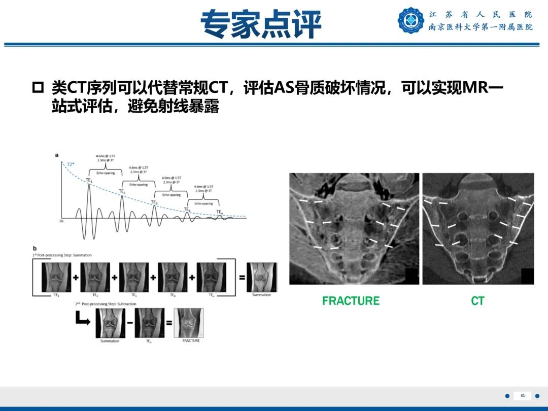 影像PPT - 【PPT】强直性脊柱炎-54