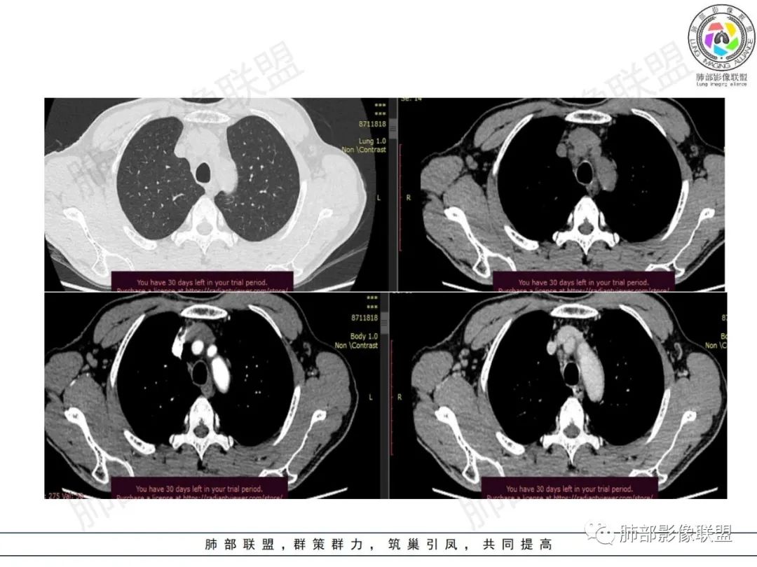 影像PPT - 【病例】HIV背景下的肺结节-3 影像PPT - 【病例】HIV背景下的肺结节-3