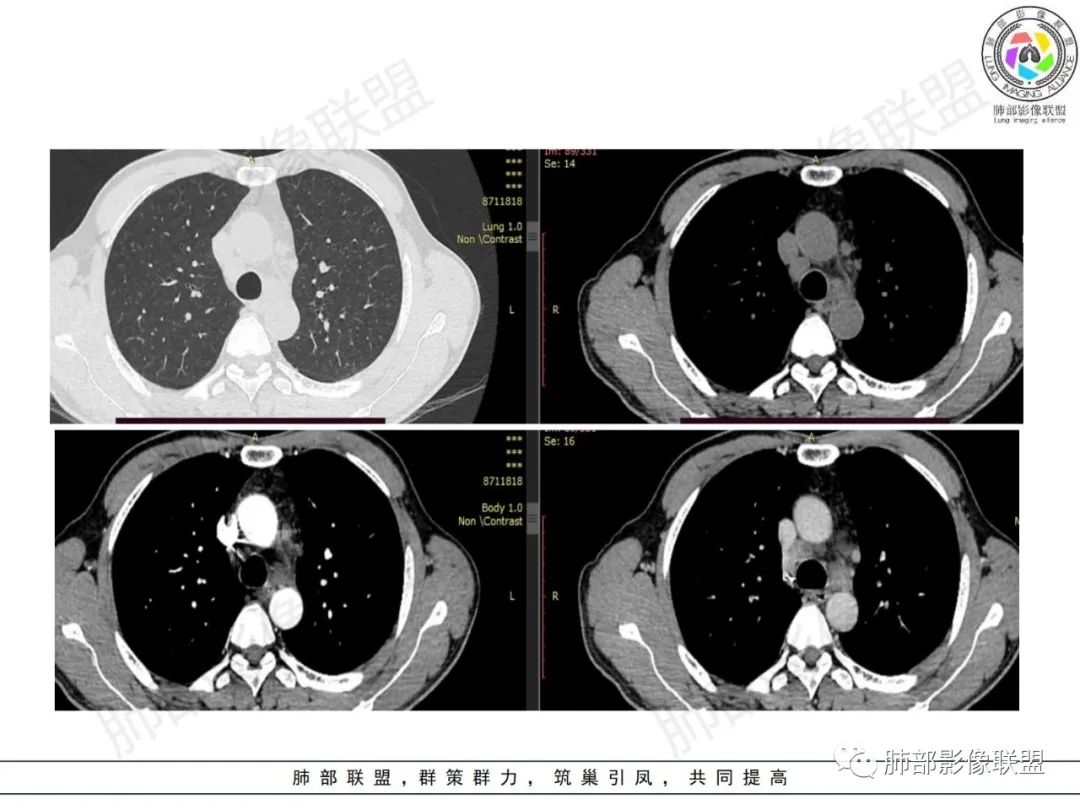 影像PPT - 【病例】HIV背景下的肺结节-4 影像PPT - 【病例】HIV背景下的肺结节-4