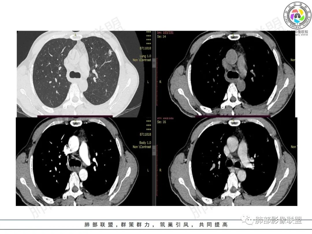 影像PPT - 【病例】HIV背景下的肺结节-5 影像PPT - 【病例】HIV背景下的肺结节-5