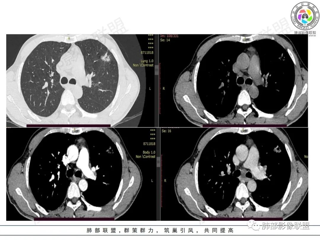 影像PPT - 【病例】HIV背景下的肺结节-6 影像PPT - 【病例】HIV背景下的肺结节-6