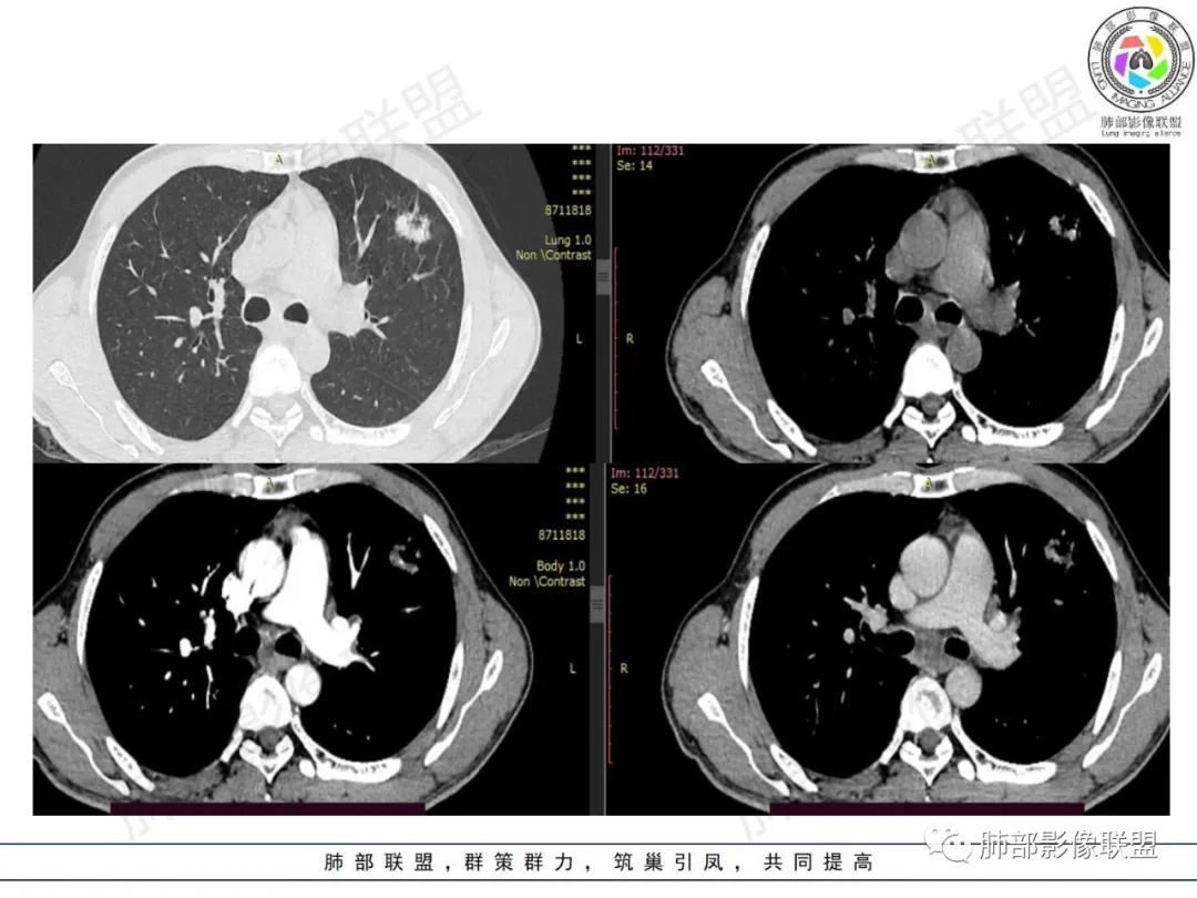 影像PPT - 【病例】HIV背景下的肺结节-7 影像PPT - 【病例】HIV背景下的肺结节-7