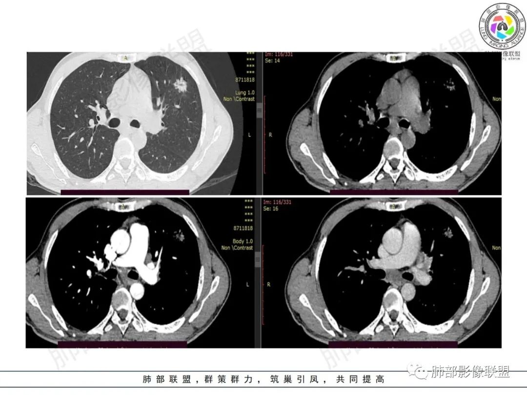 影像PPT - 【病例】HIV背景下的肺结节-8 影像PPT - 【病例】HIV背景下的肺结节-8