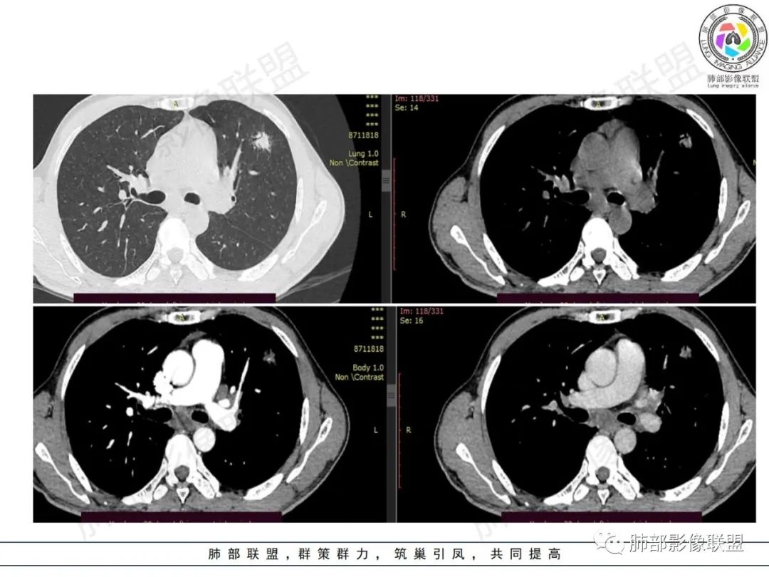 影像PPT - 【病例】HIV背景下的肺结节-9 影像PPT - 【病例】HIV背景下的肺结节-9