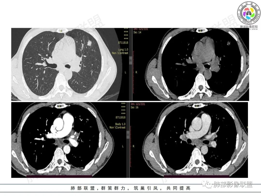 影像PPT - 【病例】HIV背景下的肺结节-10 影像PPT - 【病例】HIV背景下的肺结节-10