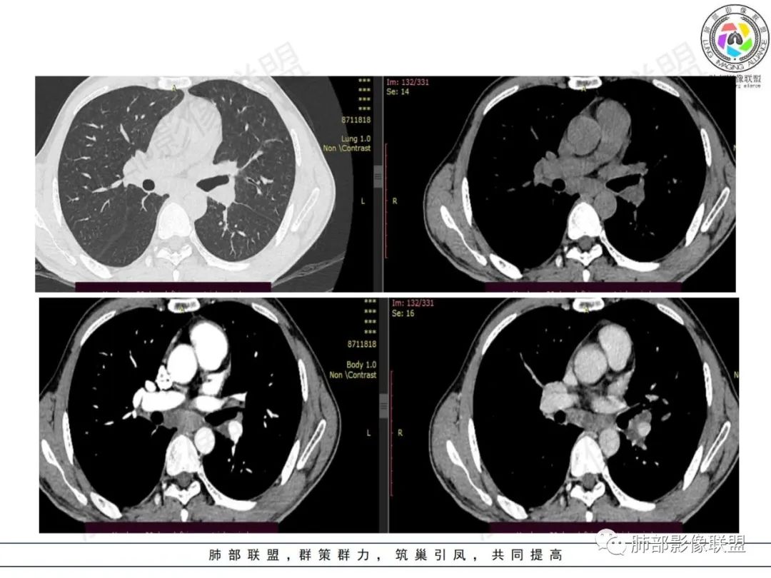影像PPT - 【病例】HIV背景下的肺结节-11 影像PPT - 【病例】HIV背景下的肺结节-11