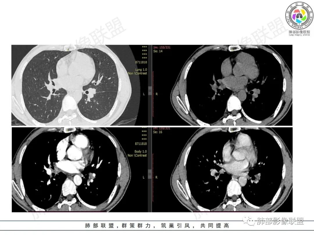 影像PPT - 【病例】HIV背景下的肺结节-13 影像PPT - 【病例】HIV背景下的肺结节-13