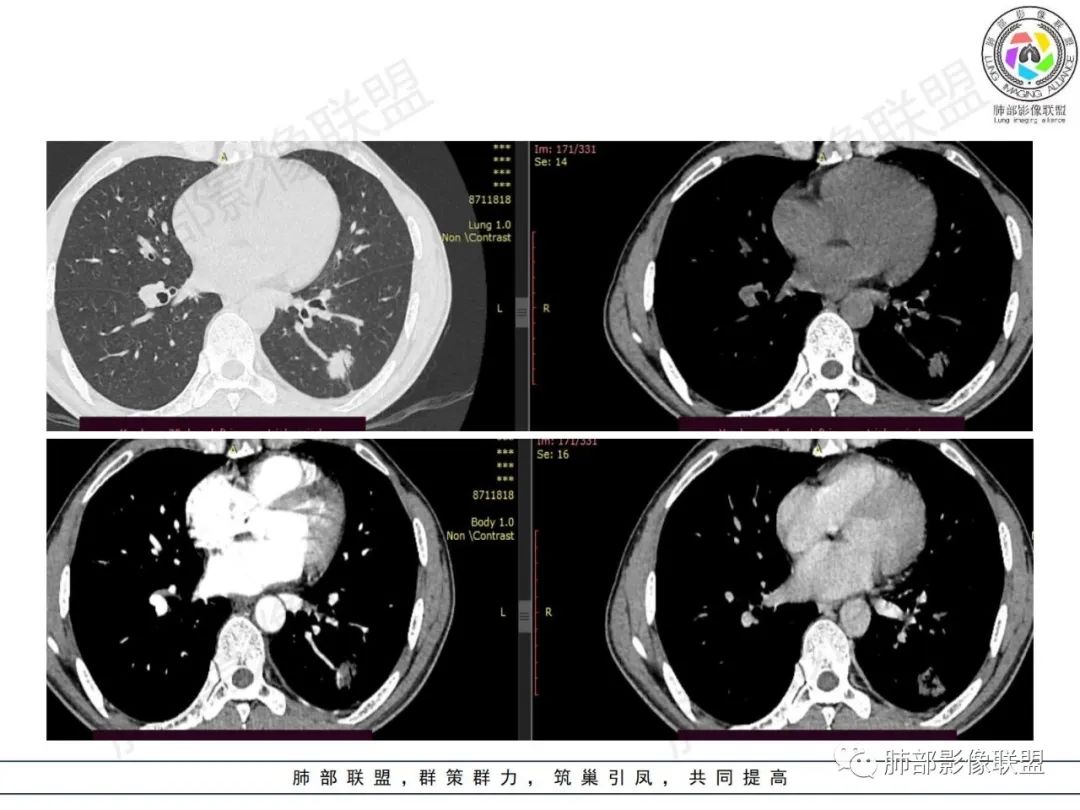 影像PPT - 【病例】HIV背景下的肺结节-14 影像PPT - 【病例】HIV背景下的肺结节-14
