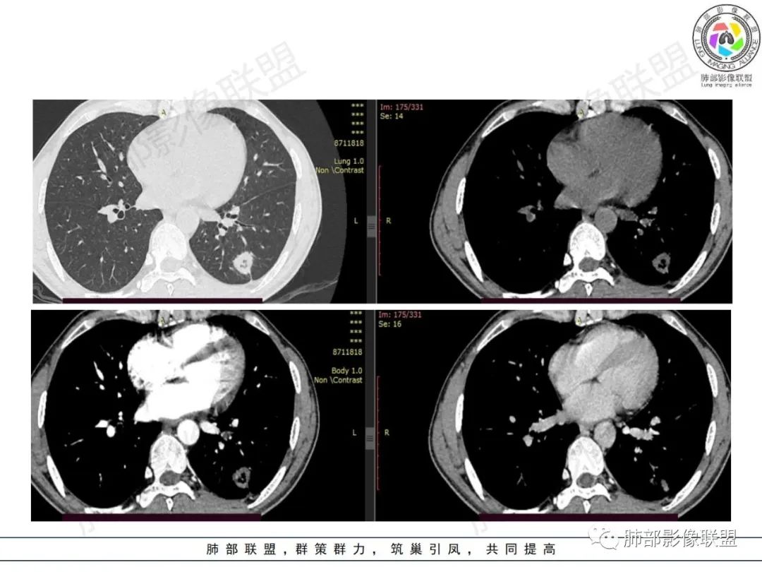 影像PPT - 【病例】HIV背景下的肺结节-15 影像PPT - 【病例】HIV背景下的肺结节-15